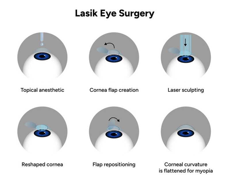 Có nhiều phương pháp phẫu thuật điều trị tật khúc xạ bằng năng lượng của tia laser