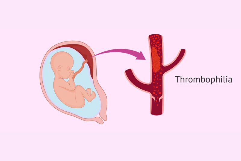 Mắc hội chứng tăng đông Thrombophilia là một trong những nguyên nhân gây ra sảy thai liên tiếp thường gặp (Ảnh: Sưu tầm)