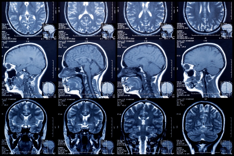 Chụp MRI sọ não giúp phát hiện sớm các bệnh lý tại não bộ 