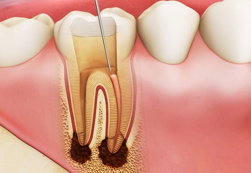 Cách điều trị viêm tủy răng là gì?