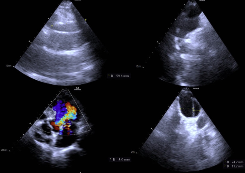 Hình ảnh siêu âm tim phát hiện tình trạng phình tách động mạch chủ lên từ đoạn gốc động mạch chủ 