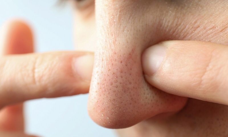Dùng tay nặn mụn đầu đen ở mũi có thể vô tình đưa vi khuẩn xâm nhập vào sâu bên trong da