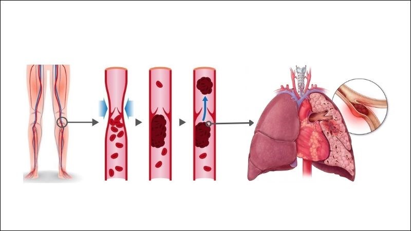 Nguyên nhân của thuyên tắc phổi chủ yếu xuất phát từ huyết khối tĩnh mạch sâu chi dưới 