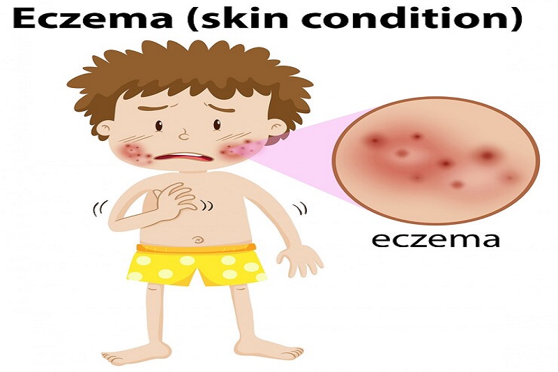 Bệnh Eczema có thể là nguyên nhân gây nên sẩn ngứa ở trẻ em