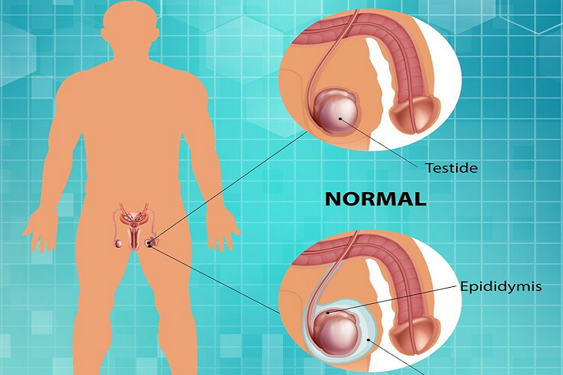 Bệnh tràn dịch màng tinh - một trong những nguyên nhân khiến tinh hoàn của trẻ sơ sinh bên to bên nhỏ