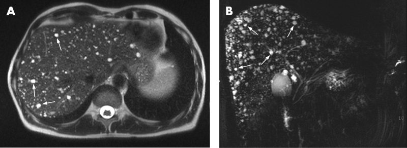 Chụp MRI gan mang lại nhiều ưu điểm vượt trội trong chẩn đoán bệnh lý gan        