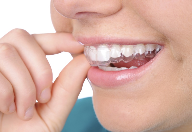 Ngậm máng tẩy trắng răng trong bao lâu?