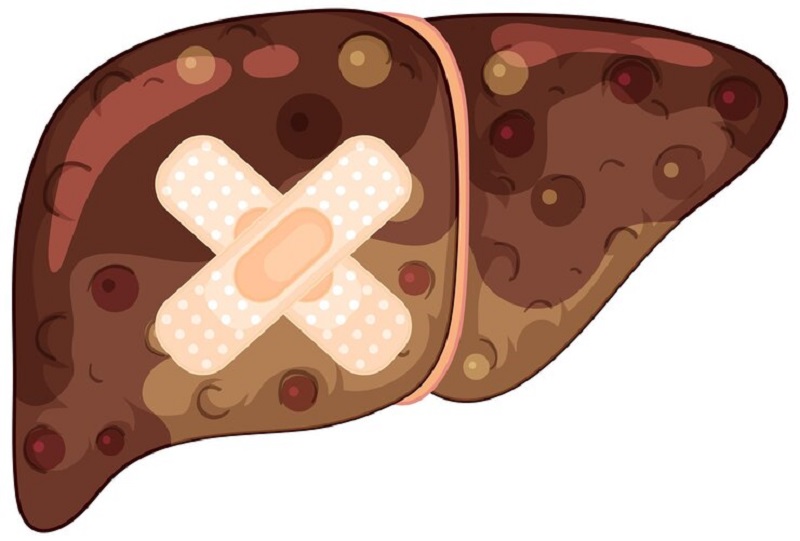 Tổn thương ở gan có thể là nguyên nhân gây nên hội chứng vàng da bệnh lý