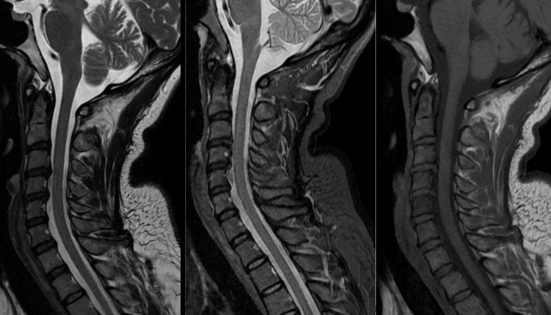 Hình ảnh chụp MRI cột sống cổ của bệnh nhân 