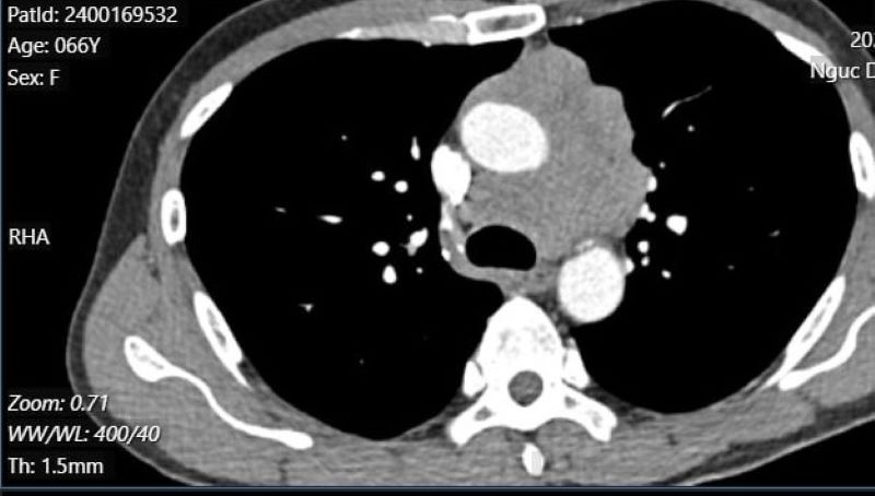 Trên hình ảnh chụp cắt lớp vi tính khối u bao quanh cung động mạch chủ và thân động mạch phổi, ngấm thuốc mạnh sau tiêm
