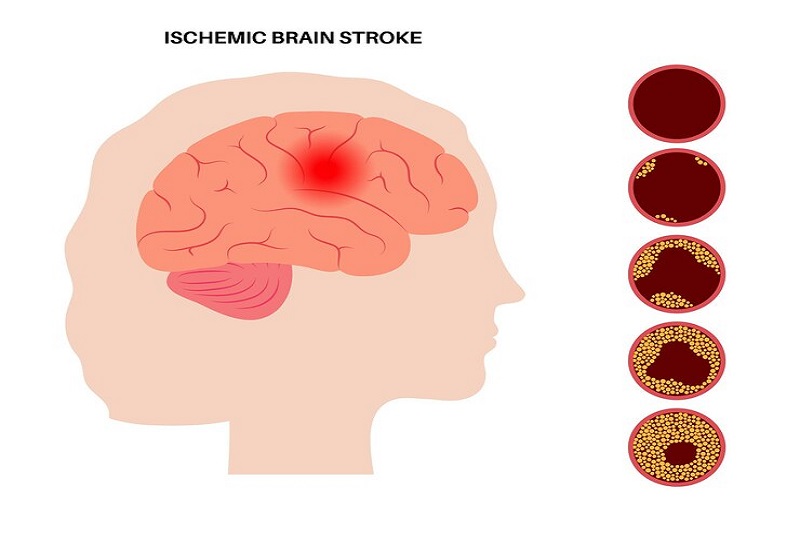 Hiện tượng nhồi máu não