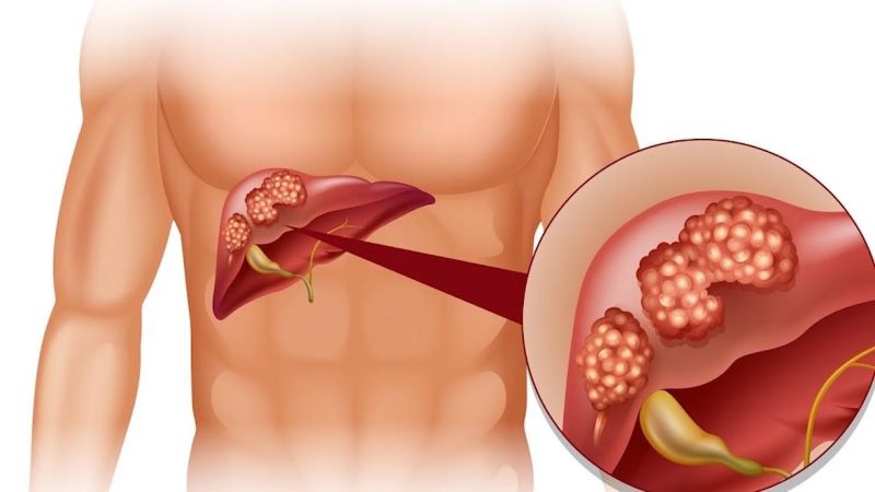 Viêm gan A do Hepatitis A Virus xâm nhập vào cơ thể 