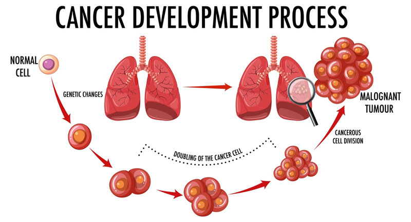 ProGRP tương tự như dấu ấn chỉ điểm ung thư phổi