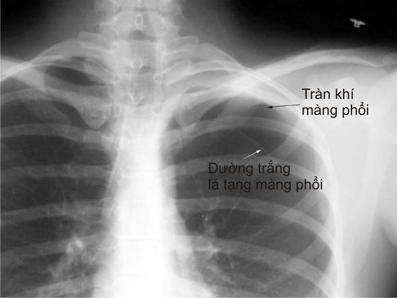 Hình ảnh chụp X-quang tràn khí màng phổi