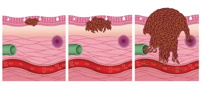 Sarcoma là bệnh ung thư hiếm gặp phát triển ở xương và mô mềm 