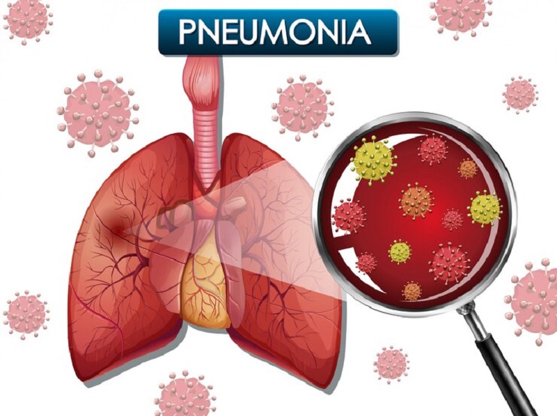 Bệnh viêm phổi không được điều trị sớm có thể biến chứng nguy hại đến tính mạng