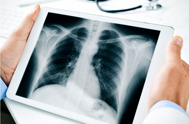 Triệu chứng và cách chữa trị u trùng thất hiệu quả Triệu chứng và cách chữa trị u trùng thất hiệu quả