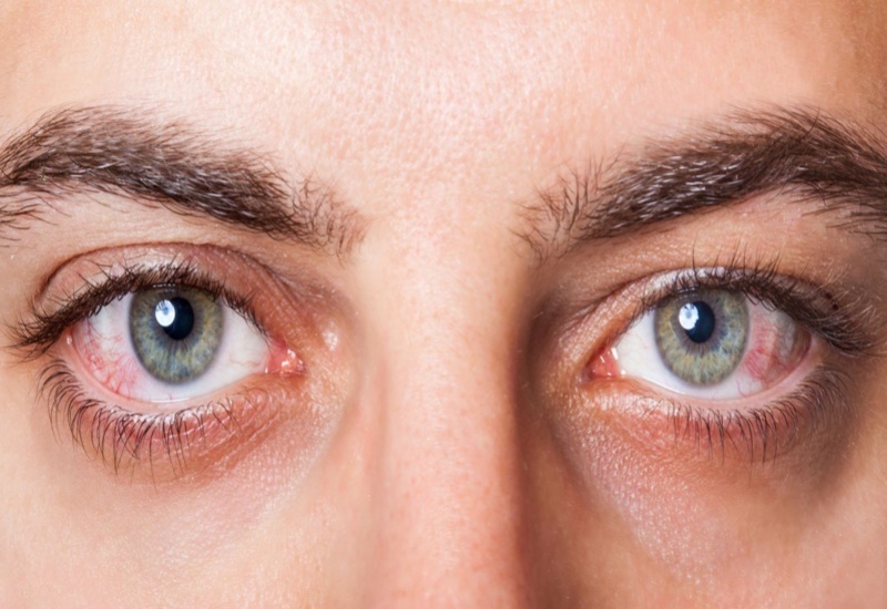 Dùng kính áp tròng trong thời gian dài có thể dẫn đến bị khô mắt