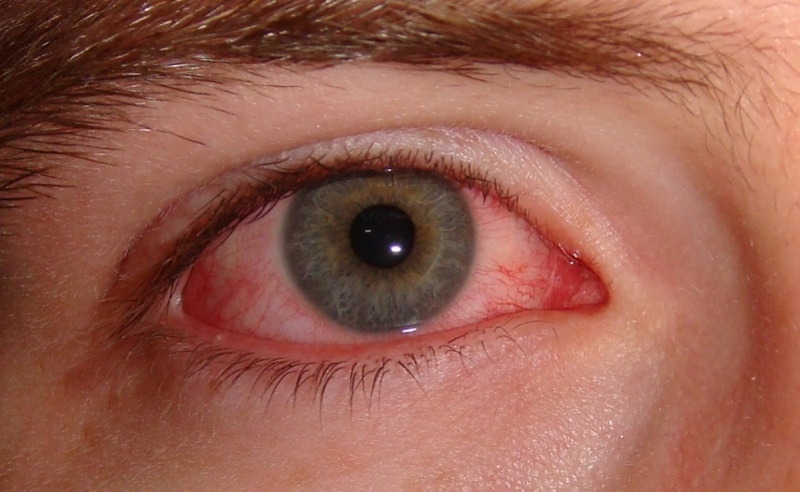 Bệnh nhân viêm màng bồ đào mắt có triệu chứng mắt đỏ bất thường 