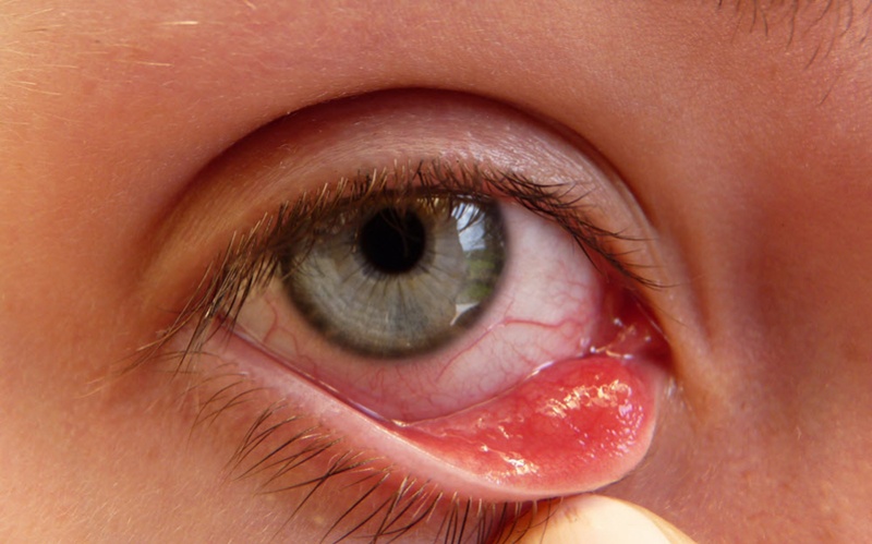 Viêm bờ mi mắt gây cảm giác khó chịu cho người bệnh