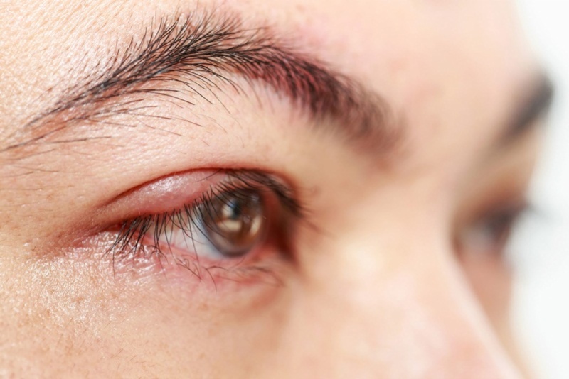 Viêm bờ mi mắt có thể khiến tầm nhìn của người bệnh bị suy giảm, nhìn mờ hơn