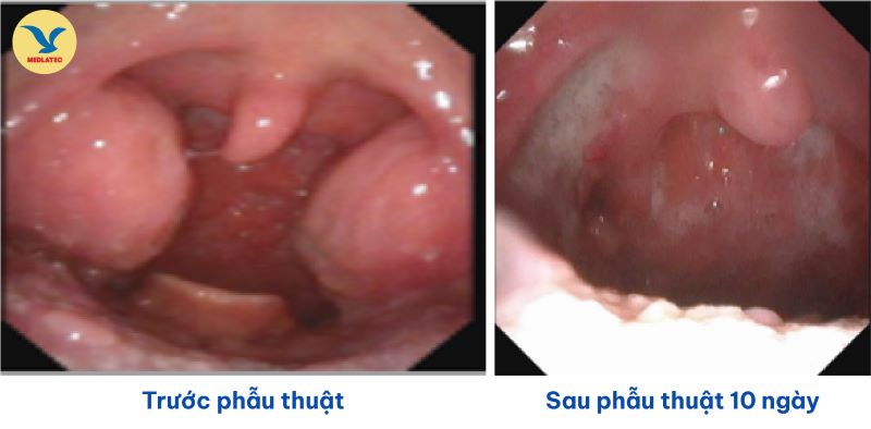 Hình ảnh Amidan trước phẫu thuật và sau phẫu thuật 10 ngày của bệnh nhân 