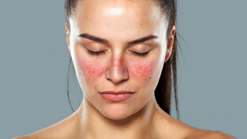 Nhiều người đặt ra thắc mắc liệu bệnh lupus ban đỏ có di truyền không?