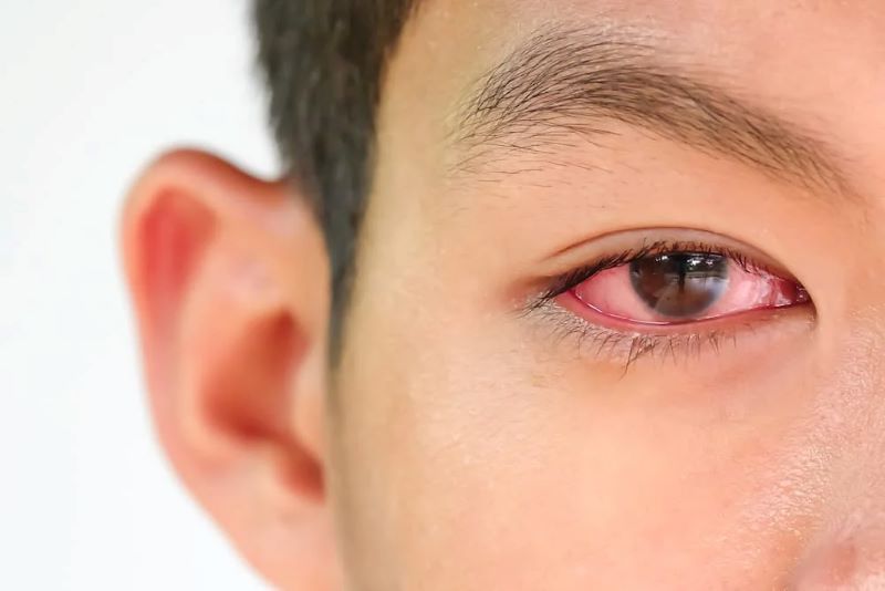 Đau mắt đỏ có thể lây nhiễm qua tiếp xúc và nguy cơ bùng phát thành dịch