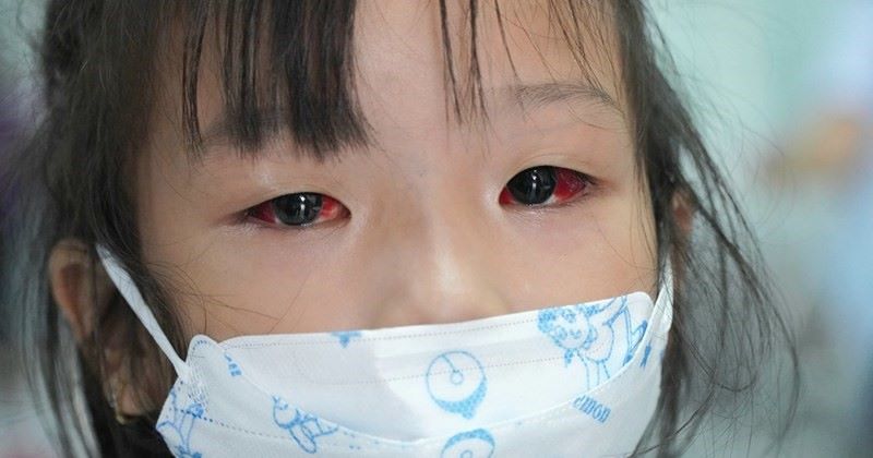 Đau mắt đỏ có thể xảy ra với bất kỳ ai dù là người lớn hay trẻ em