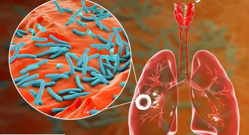 M.Tuberculosis có thể xâm nhập, trú ngụ, sinh sôi tại phổi và gây bệnh lao