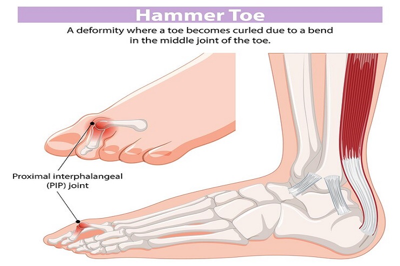 Xương bàn chân bị lệch gây ngón chân hình búa