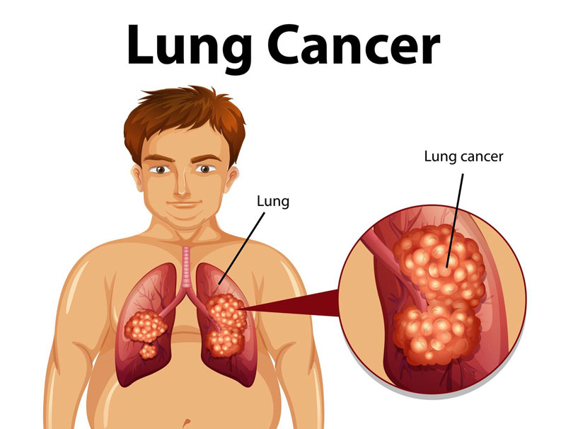 Ung thư phổi được chia thành nhiều loại khác nhau
