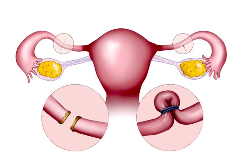 Nhiều chị em thắc mắc sau khi thắt ống dẫn trứng có kinh nguyệt không? 