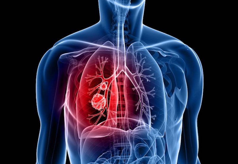 U phổi có thể được chữa khỏi không?