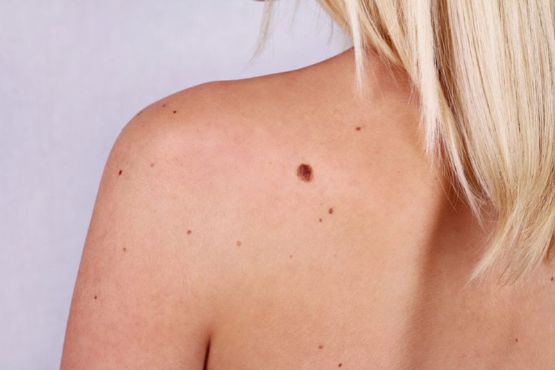 Nốt ruồi trở nên bất thường, thay đổi nhanh chóng về kích thước có thể là một dấu hiệu cảnh báo nguy cơ ung thư da 