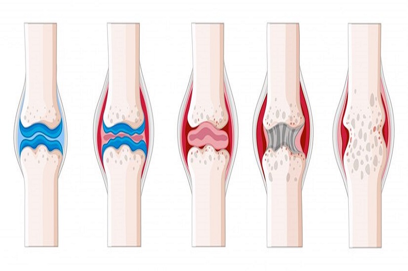 Viêm khớp dạng thấp có thể khiến huyết tương bị đục