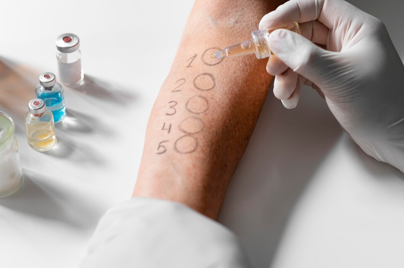 Test lẩy da có thể xác định phản ứng của cơ thể với 50 dị nguyên khác nhau 