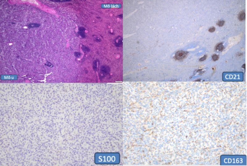 Kết quả nhuộm H&E và hoá mô miễn dịch thấy u tăng sinh nhiều xoang mạch, xung quanh có nhiều mô bào dương tính với CD163 và âm tính CD21, S100 