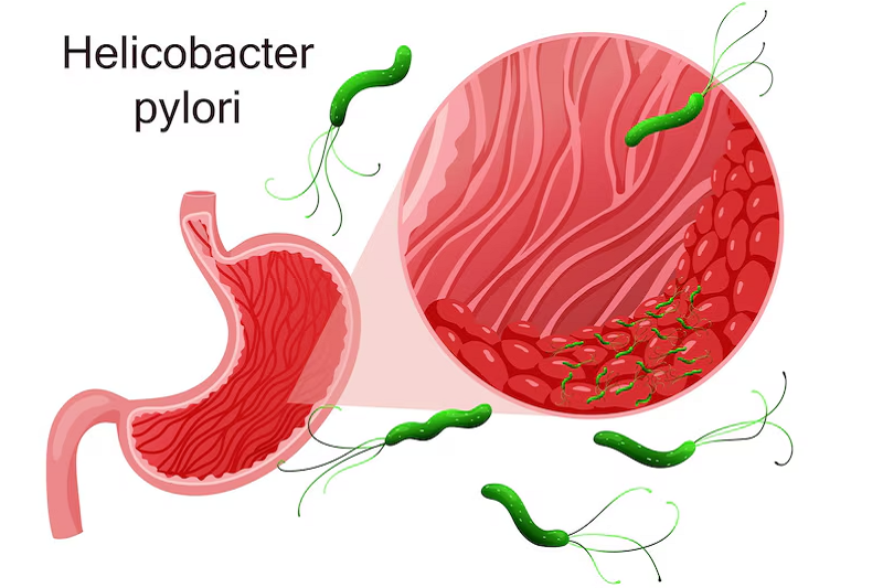 Hình ảnh vi khuẩn Helicobacter pylori gây nên viêm loét dạ dày