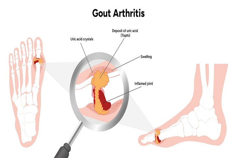 Mặc bệnh Gout làm tăng nguy cơ viêm bao hoạt dịch cổ tay