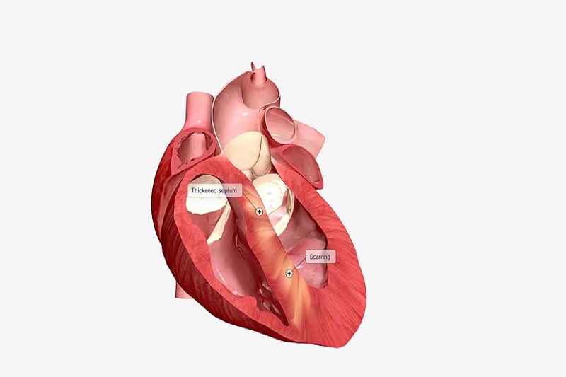 Thành tâm thất dày lên trong bệnh cơ tim phì đại