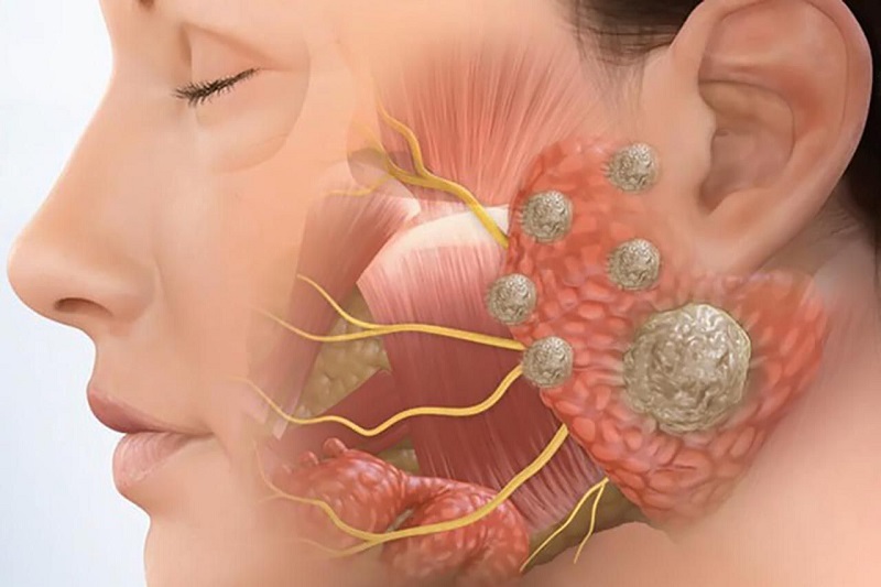 Những triệu chứng và dấu hiệu của u tuyến nước bọt mang tai là gì?
