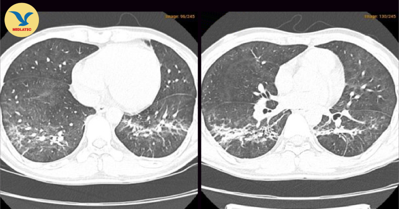 Hình ảnh chụp cắt lớp vi tính phổi độ phân giải cao của bệnh nhân 