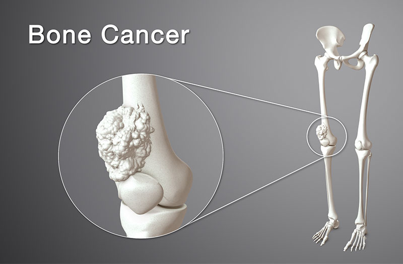 Nguyên nhân gây ra ung thư xương là gì?
