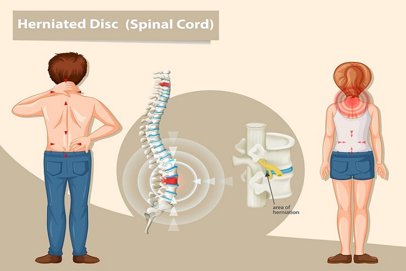 Thoát vị địa đệm ảnh hưởng đến tủy sống, gây đau đớn cho người bệnh