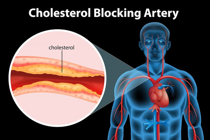 Tăng cholesterol ở nam giới gây nguy cơ mắc bệnh tim mạch