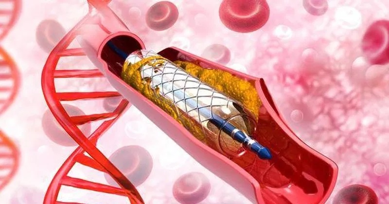 Mô phỏng đặt stent mạch vành