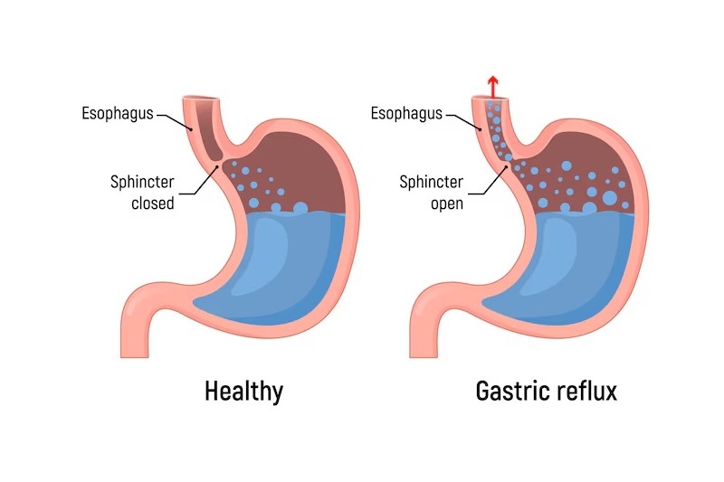 Hình ảnh mô phỏng hiện tượng trào ngược dạ dày thực quản