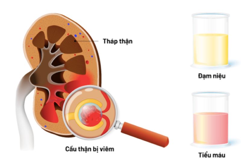 Viêm cầu thận cấp tính ở trẻ có thể gây ra những biến chứng nguy hiểm 