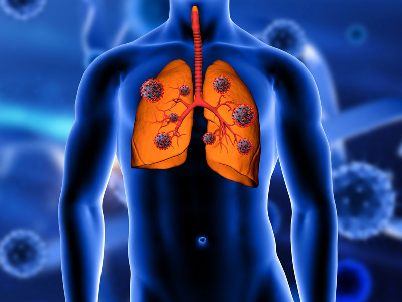 Người thể trạng yếu khi mắc cúm dễ gặp phải biến chứng viêm phổi